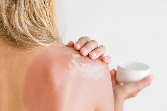 Best ways to treat sunburns and sunbed burns